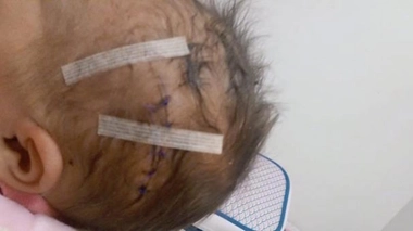 Insolite : un bébé reçoit un coup de scalpel lors d'une césarienne !