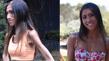 Anorexie : elle partage les photos de son rétablissement sur Instagram