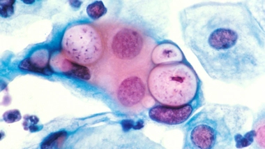 Chlamydia : faites-vous dépister !