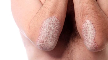 Journée mondiale du psoriasis 2018  : mieux connaître le rhumatisme psoriasique