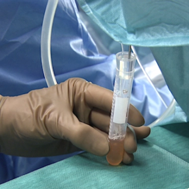 La ponction a lieu le plus souvent sous anesthésie générale