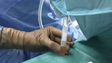 La ponction a lieu le plus souvent sous anesthésie générale