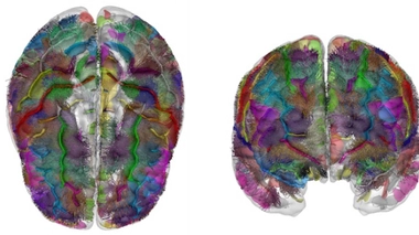 Visualisation en 3D des faisceaux courtes distances. Crédit : Cyril Poupon, Jean-François Mangin et Miguel Guevara.