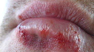 90% de la population sont porteurs d'anticorps anti-herpès