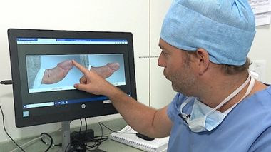 Maladie de Lapeyronie : le pénis coudé