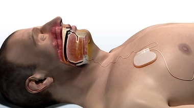 Dispositifs médicaux implantables : de quoi parle-t-on ?