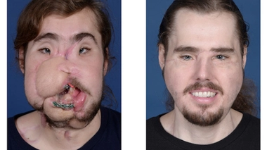 Cameron Underwood avant et après la greffe