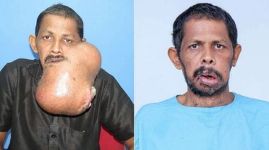 L’indien savoure aujourd’hui sa nouvelle vie après avoir été débarrassé de son énorme tumeur de 5,3 kg.