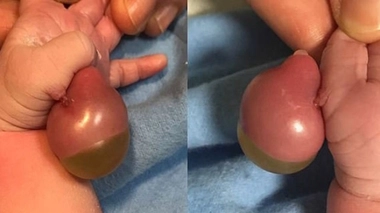 Un bébé naît avec une énorme bosse rouge luisante sous le pouce