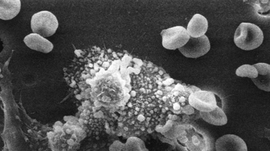 Les macrophages fusionnent avec les cellules cancéreuses et injectent leurs toxines.