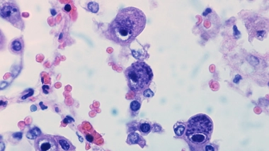 Ce mécanisme pourrait jouer un rôle dans le développement d'autres maladies telles que l'encéphalite, la pneumonie, l'hépatite et même la maladie d'Alzheimer.