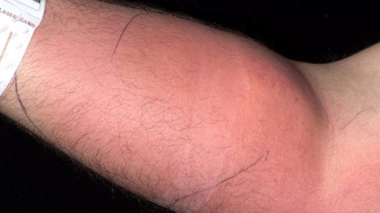 L'homme a développé une grave infection bactérienne appelée "cellulite"