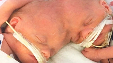 Opération de séparation réussie pour deux siamoises reliées par la tête