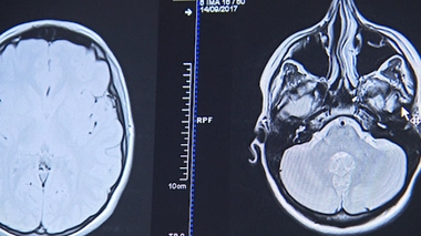 SEP : les bénéfices des traitements de fond