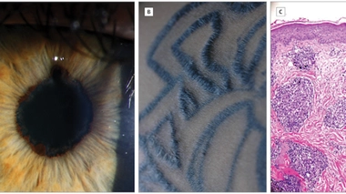 De gauche à droite : oeil gauche du patient, tatouage du bras gauche, échantillon de la biopsie