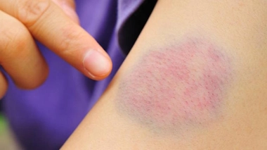 Au total, plus de 7.000 personnes pourraient bénéficier d’HEMOmooc