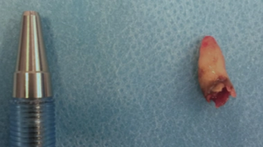 La dent intranasale après extraction par chirurgie.