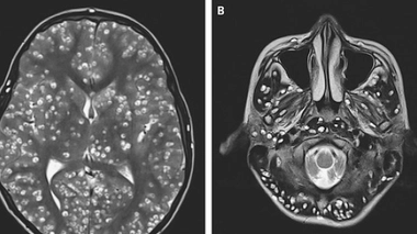 Un Indien meurt d’une invasion de larves de ténia dans son cerveau
