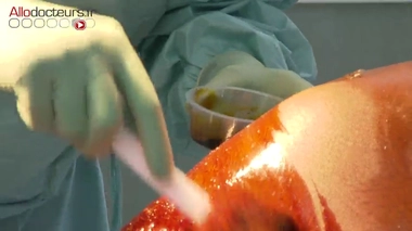 La césarienne met-elle les femmes en danger ?