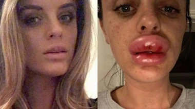 Certains actes esthétiques tels que le comblement des lèvres provoquent des risques d'infections et de kystes