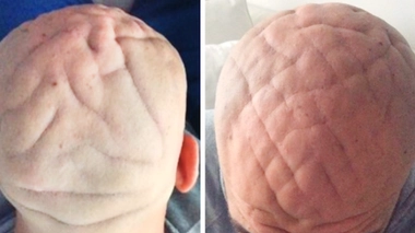 La peau de son crâne a un aspect matelassé… il souffre en fait d’acromégalie