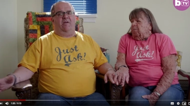 Mariés depuis 10 ans, ils sont tous les deux atteints de neurofibromatose