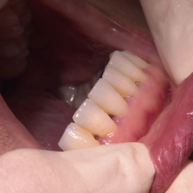 Gencives : prévenir pour garder le sourire