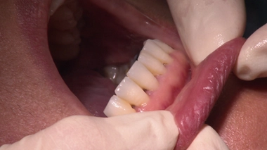 Gencives : prévenir pour garder le sourire