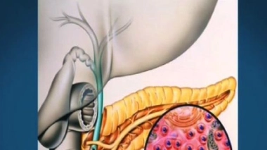 Le pancréas, une autre victime de l'alcool