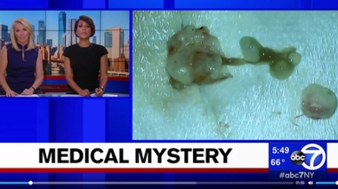 Elle pensait avoir une tumeur au cerveau… c’était un ver !