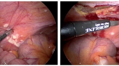 Cancer : nouvel espoir de la chimiothérapie par aérosol