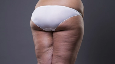 Le lipoedème, une maladie du tissu graisseux