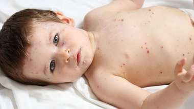 Varicelle : faut-il s’inquiéter de l’épidémie en cours ?