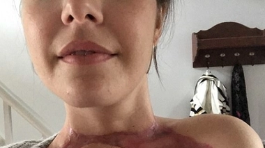 On lui diagnostique une amygdalite… c’était une infection nécrosante