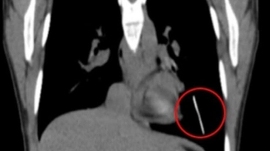 Son implant contraceptif glisse dans son poumon !