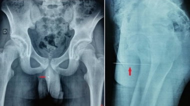 Il n’arrive plus à uriner… on retire une aiguille de 9 cm de son pénis