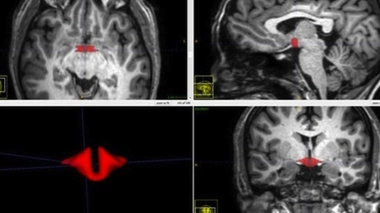 En rouge : l'hypothalamus, plus petit chez les femmes qui prennent la pilule.