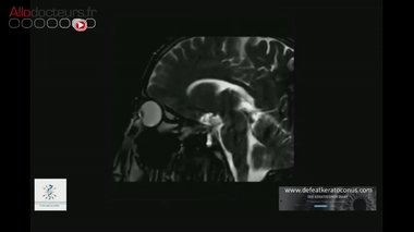 Trop se frotter les yeux peut nuire à votre vue