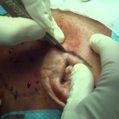 Glandes salivaires : les tumeurs de la glande parotide