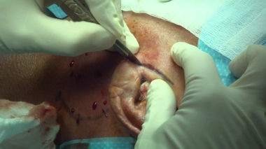 Glandes salivaires : les tumeurs de la glande parotide