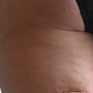 Cellulite : le mal des femmes