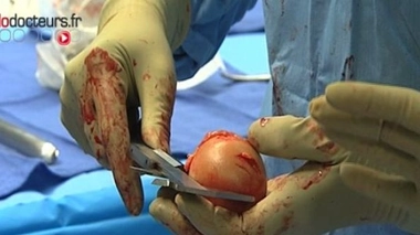 Fracture du col du fémur : plus dure sera la chute