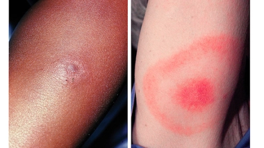 L'érythème migrant est le signe le plus classique et le plus précoce de la maladie de Lyme.