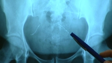 Image d'illustration. Visualisation sur une radiographie de l'abdomen de deux implants Essure.