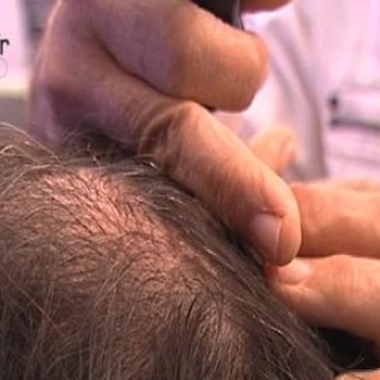 Calvitie : pourquoi nos cheveux nous lâchent !