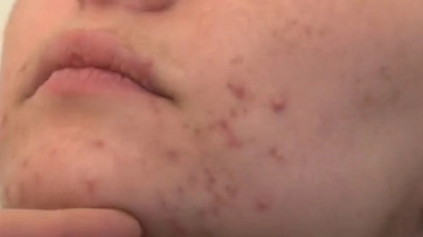 Isotrétinoïne : un traitement dangereux pour les femmes enceintes