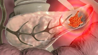 Image d'illustration. Représentation 3D d'une tumeur au niveau du pancréas.