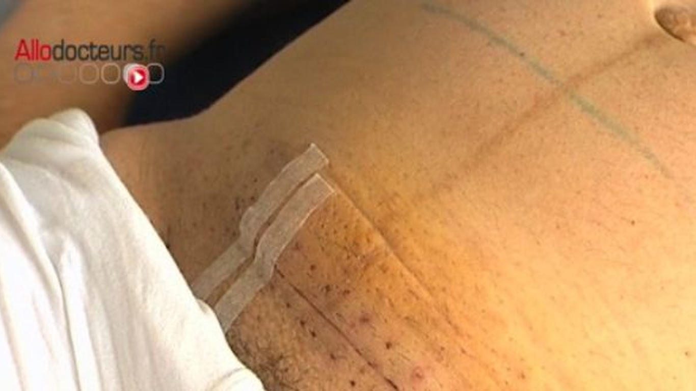 Césarienne : l'accouchement chirurgical - Allo Docteurs