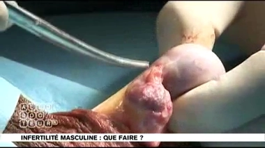 Infertilité masculine : une biopsie du testicule ?