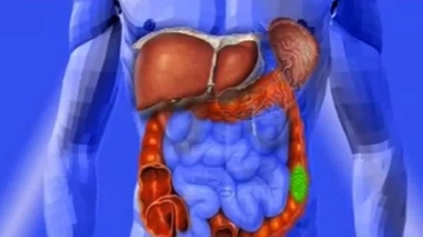 Opérer le cancer du côlon